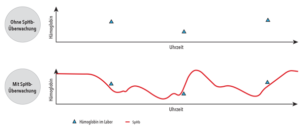 Masimo - SpHb - Mehrwert der SpHb-Überwachung Graph