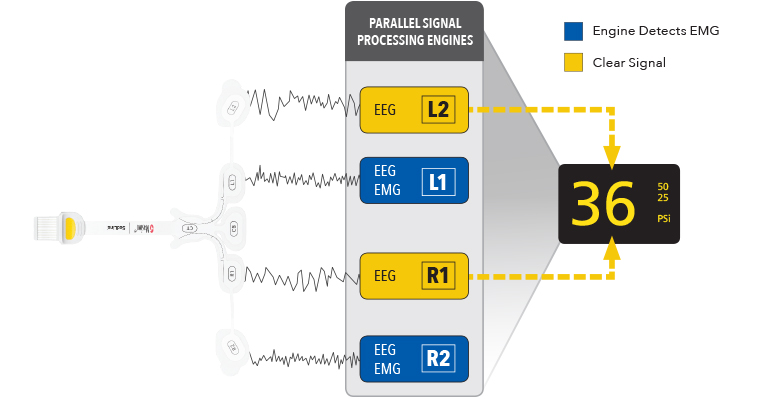 Masimo – Parallele Signalverarbeitungs-Engines